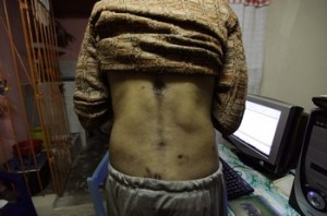 Guillermo Fariñas muestra las heridas que sufrió durante la guerra de Angola. Foto tomada el 26 de febrero de 2010/Reuters